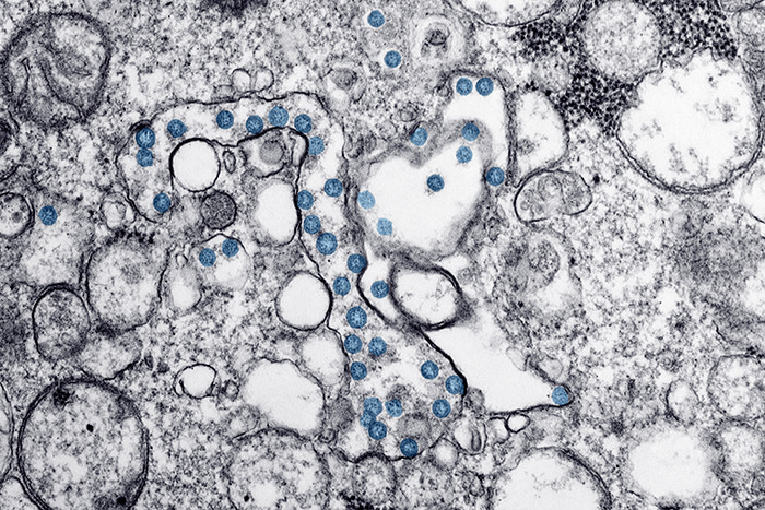 This 2020 electron microscope image made available by the U.S. Centers for Disease Control and Prevention shows the spherical particles of the new coronavirus, colorized blue, from the first U.S. case of COVID-19. Antibody blood tests for the coronavirus could play a key role in deciding whether millions of Americans can safely return to work and school. But public health officials warn that the current ‚ÄúWild West‚Äù of unregulated tests is creating confusion that could ultimately slow the path to recovery. (Hannah A. Bullock, Azaibi Tamin/CDC via AP)