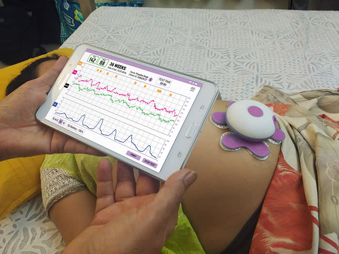 An AI-powered foetal monitor developed by start-up Sattva MedTech