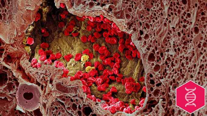 Colour-enhanced, freeze-fracture scanning electron micrograph of a blood vessel that has grown into a melanoma and is providing nourishment to it. Numerous red blood cells (coloured red) and three white blood cells (coloured yellow) can be seen within the blood vessel (coloured yellow/green). This is surrounded by the melanoma (coloured brown) which is from mouse skin. Horizontal width of image is approximately 230 micrometres. Biomedical Image Awards 2002.