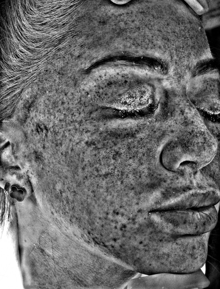 ...showing the effects of sun damage on the skin