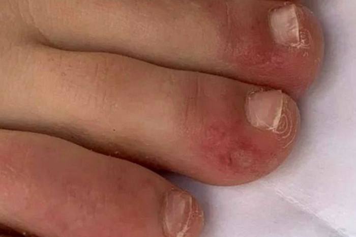 Some symptoms are relatively mild, such as chilblain-like sores on the toes