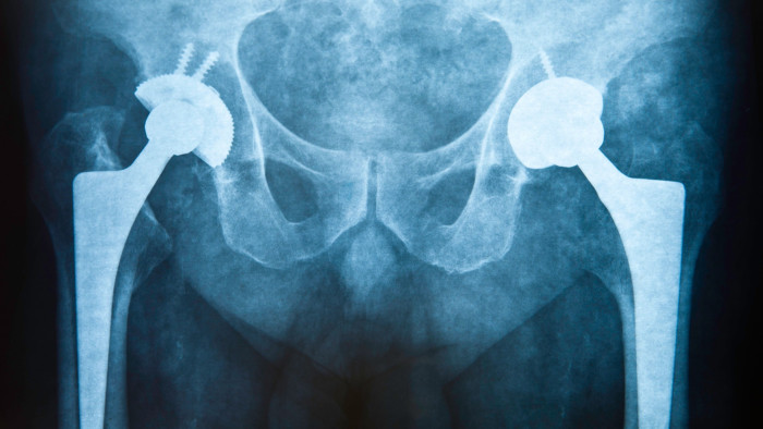 An x-ray of a person’s hip