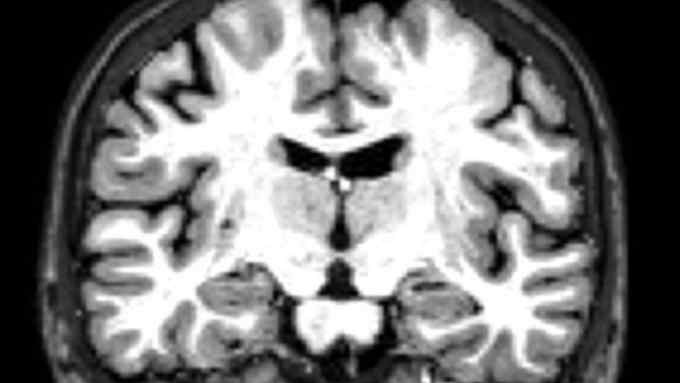 Seasonal Appeal - Alzheimer's Research UK,  Healthy brain MRI